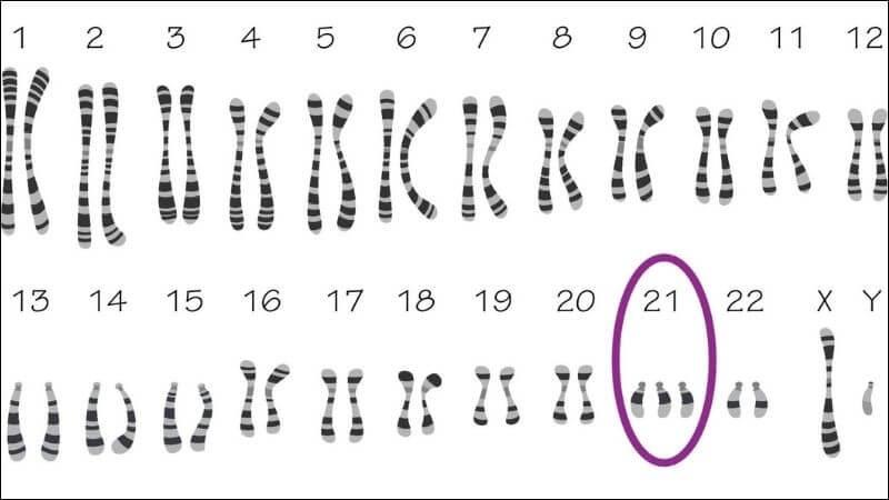 Hội chứng Down: Nguyên nhân, triệu chứng và sàng lọc bệnh