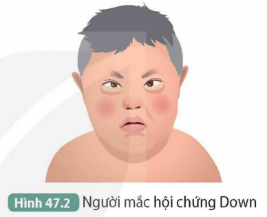 I. TÍNH TRẠNG Ở NGƯỜIHoạt động 1: Quan sát Hình 47.1, xác định những tính trạng quan sát được. Xác định kiểu hình của em đối với mỗi tính trạng vừa nêu.Giải nhanh:- Các tính trạng: chiều cao, dạng tóc, màu mắt, màu da,…- Kiểu hình đối với mỗi tính trạng là: tóc thẳng, da trắng, mắt đen, mũi cao…Hoạt động 2: Ngoài những tính trạng quan sát được ở Hình 47.1, nêu thêm một số ví dụ về tính trạng ở người.Giải nhanh:Tính trạng nhận biết màu sắc, nhóm máu, tính cách,…II. BỆNH VÀ TẬT DI TRUYỀN Ở NGƯỜICâu hỏi 1: Đọc thông tin trong mục II và quan sát các Hình 47.2, 47.3, 47.4, cho biết đặc điểm nào giúp phân biệt bệnh và tật di truyền. Giải nhanh:Bệnh di truyền là các rối loạn cấu tạo sinh lí bẩm sinh, gây nguy hiểm đến sức khỏe, còn tật di truyền là các khiếm khuyết về hình thái bẩm sinh và nó không gây nguy hiểm đến sức khỏe.Câu hỏi 2: Nêu thêm một số hội chứng, bệnh và tật di truyền ở người.Giải nhanh:- Hội chứng di truyền: Edwards, hội chứng Patau,..- Bệnh di truyền: bệnh teo cơ duchenne, bệnh Huntington,…- Tật di truyền: tật di truyền về màu mắt, tật di truyền dấu vân tay đặc biệt,…III. MỘT SỐ TÁC NHÂN GÂY BỆNH DI TRUYỀN Câu hỏi: Cần làm gì để hạn chế tác nhân gây bệnh di truyền?Giải nhanh:- Tránh xa các chất gây hại như hóa chất độc hại, thuốc lá, rượu,…- Giữ gìn vệ sinh môi trường xung quanh luôn sạch sẽ.- Khi ra ngoài, che chắn cẩn thận, tránh tiếp xúc trực tiếp với tia UV…IV. VAI TRÒ CỦA DI TRUYỀN HỌC VỚI HÔN NHÂN