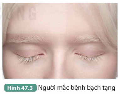 I. TÍNH TRẠNG Ở NGƯỜIHoạt động 1: Quan sát Hình 47.1, xác định những tính trạng quan sát được. Xác định kiểu hình của em đối với mỗi tính trạng vừa nêu.Giải nhanh:- Các tính trạng: chiều cao, dạng tóc, màu mắt, màu da,…- Kiểu hình đối với mỗi tính trạng là: tóc thẳng, da trắng, mắt đen, mũi cao…Hoạt động 2: Ngoài những tính trạng quan sát được ở Hình 47.1, nêu thêm một số ví dụ về tính trạng ở người.Giải nhanh:Tính trạng nhận biết màu sắc, nhóm máu, tính cách,…II. BỆNH VÀ TẬT DI TRUYỀN Ở NGƯỜICâu hỏi 1: Đọc thông tin trong mục II và quan sát các Hình 47.2, 47.3, 47.4, cho biết đặc điểm nào giúp phân biệt bệnh và tật di truyền. Giải nhanh:Bệnh di truyền là các rối loạn cấu tạo sinh lí bẩm sinh, gây nguy hiểm đến sức khỏe, còn tật di truyền là các khiếm khuyết về hình thái bẩm sinh và nó không gây nguy hiểm đến sức khỏe.Câu hỏi 2: Nêu thêm một số hội chứng, bệnh và tật di truyền ở người.Giải nhanh:- Hội chứng di truyền: Edwards, hội chứng Patau,..- Bệnh di truyền: bệnh teo cơ duchenne, bệnh Huntington,…- Tật di truyền: tật di truyền về màu mắt, tật di truyền dấu vân tay đặc biệt,…III. MỘT SỐ TÁC NHÂN GÂY BỆNH DI TRUYỀN Câu hỏi: Cần làm gì để hạn chế tác nhân gây bệnh di truyền?Giải nhanh:- Tránh xa các chất gây hại như hóa chất độc hại, thuốc lá, rượu,…- Giữ gìn vệ sinh môi trường xung quanh luôn sạch sẽ.- Khi ra ngoài, che chắn cẩn thận, tránh tiếp xúc trực tiếp với tia UV…IV. VAI TRÒ CỦA DI TRUYỀN HỌC VỚI HÔN NHÂN