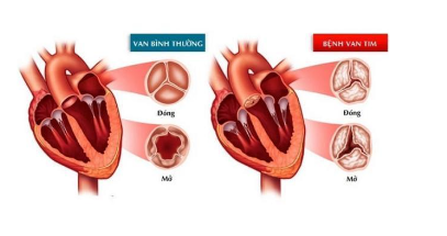 Bệnh về hệ tuần hoàn